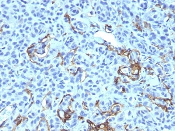 IHC: Formalin-fixed, paraffin-embedded human melanoma stained with NGF Receptor antibody (NGFR5 + NT