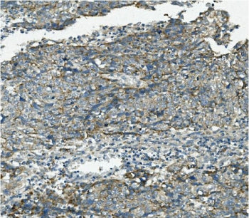 IHC staining of FFPE human lung cancer with VPS4B antibody. HIER: boil tissue sections in pH8 EDTA f