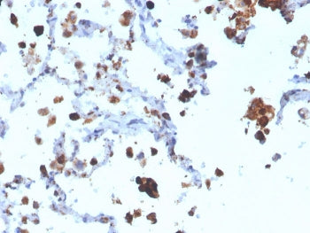 IHC staining of FFPE human lung adenocarcinoma with Napsin A antibody (clone NAPSA/3308). HIER: boil
