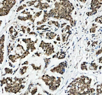 IHC staining of FFPE human breast cancer tissue with Histone H2AX antibody. HIER: boil tissue sectio