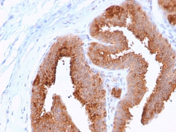 IHC staining of FFPE human breast carcinoma with HER4 antibody (clone ERBB4/2581). HIER: boil tissue