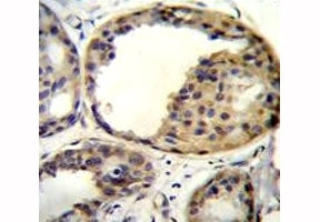 AKT1 antibody immunohistochemistry analysis in formalin fixed and paraffin embedded human breast car