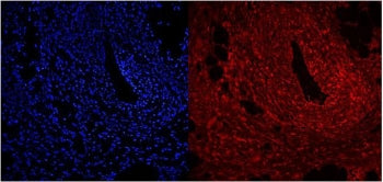 Immunofluorescent staining of FFPE human intestinal cancer with NFIC antibody (red) and DAPI nuclear