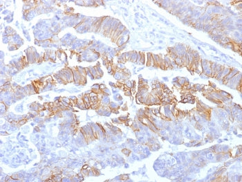 IHC testing of formalin-fixed, paraffin-embedded human colon carcinoma with recombinant E-Cadherin a