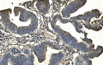 IHC staining of FFPE human rectal cancer with ANPEP antibody. HIER: boil tissue sections in pH8 EDTA