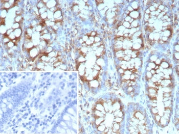 IHC staining of FFPE human colon carcinoma tissue with recombinant Stathmin 1 antibody (clone STMN1/