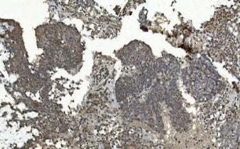 IHC staining of FFPE human lung cancer with MAPK7 antibody. HIER: boil tissue sections in pH8 EDTA f