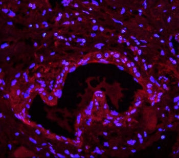 Immunofluorescent staining of FFPE human breast cancer with LIN28A antibody (red) and DAPI nuclear s