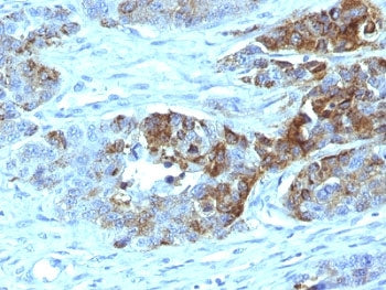 IHC: Formalin-fixed, paraffin-embedded human colon carcinoma stained with Blood Group Antigen H Type