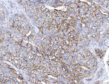 IHC staining of FFPE human liver cancer tissue with PC-1 antibody. HIER: boil tissue sections in pH8