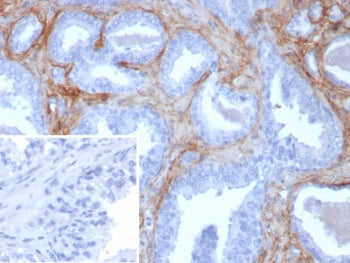 IHC staining of FFPE human prostate tissue with recombinant POSTN antibody (clone rPOSTN/8522). Inse