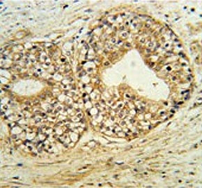 IHC testing of FFPE human prostate carcinoma tissue with Phospholipid-transporting ATPase IG antibod