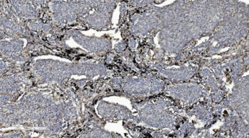 IHC staining of FFPE human lung cancer with CMBL antibody. HIER: boil tissue sections in pH8 EDTA fo