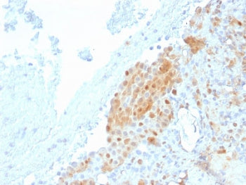 IHC testing of FFPE human Mesothelioma with Calbindin 2 antibody (clone CALB2/2685). HIER: boil tiss