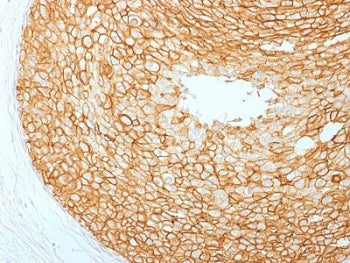 IHC testing of FFPE human breast carcinoma with HER2 antibody. HIER: boil tissue sections in pH6, 10