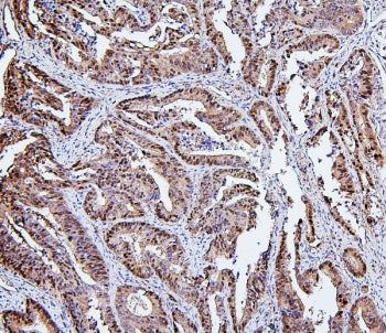 IHC staining of FFPE human intestinal cancer with Hsp105 Antibody antibody. HIER: boil tissue sectio