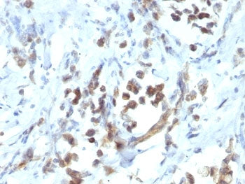 IHC: Formalin-fixed, paraffin-embedded human gastric carcinoma stained with PAX6 antibody (PAX6/1166