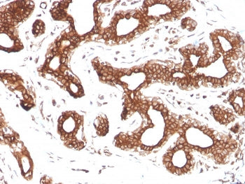 IHC staining of FFPE human breast carcinoma with Calpastatin antibody (clone CAST/1550). HIER: boil 