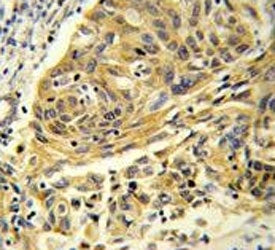 IHC testing of FFPE human lung carcinoma tissue with Clathrin Light Chain A antibody. HIER: steam se