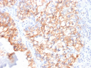 IHC testing of FFPE human renal cell carcinoma with Cadherin 16 antibody (clone CDH16/2125). Require