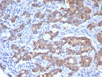 IHC staining of FFPE human colon adenocarcinoma with VIL1 antibody (clone rVIL1/8336). HIER: boil ti