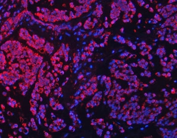 Immunofluorescent staining of FFPE human breast cancer tissue with Transcription factor EB antibody 