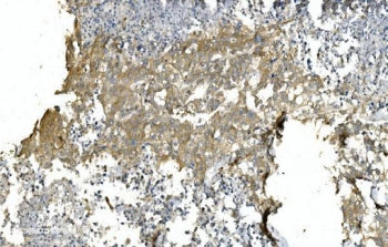 IHC staining of FFPE human pancreatic cancer with TUBA1 antibody. HIER: boil tissue sections in pH8 