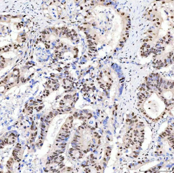 Immunohistochemical staining of SRRT using anti-SRRT antibody. SRRT was detected in a paraffin-embed