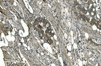 IHC staining of FFPE human renal carcinoma with GNG7 antibody. HIER: boil tissue sections in pH8 EDT