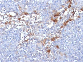 IHC: Formalin-fixed, paraffin-embedded human melanoma stained with CD146 antibody (clone MUC18/1130)