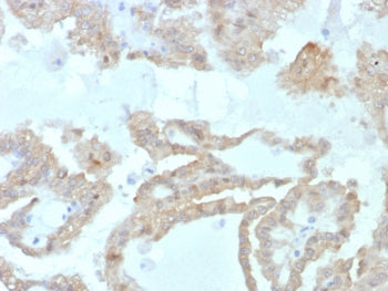 IHC staining of FFPE human renal cell carcinoma tissue with FABP2 antibody (clone FABP2/7669). HIER: