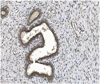 IHC staining of FFPE human breast cancer with EIF2B1 antibody. HIER: boil tissue sections in pH8 EDT