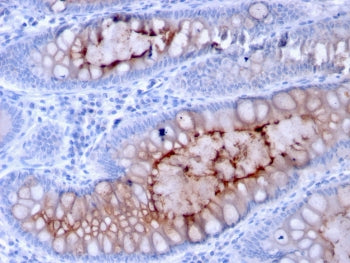 IHC testing of FFPE human colon carcinoma with MUC4 antibody (clone MUC4/3084). HIER: requires steam