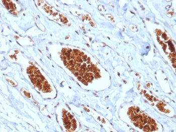 IHC testing of FFPE human angiosarcoma with recombinant GYPA antibody (clone rGYPA/280). Required HI