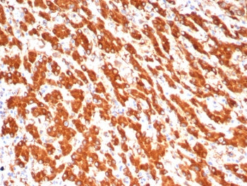 IHC staining of FFPE human hepatocellular carcinoma tissue with ADH1L1 antibody (clone ALDH1L1/7702)