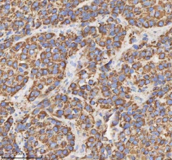 IHC staining of FFPE human liver cancer tissue with HADH antibody. HIER: boil tissue sections in pH8