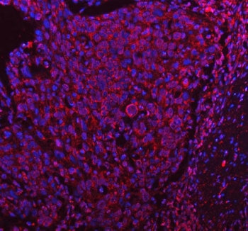 Immunofluorescent staining of FFPE human squamous cell carcinoma tissue with Pyruvate dehydrogenase 