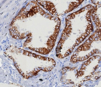 IHC staining of FFPE human prostate carcinoma tissue with EpCAM antibody (clone EGP40/8130R). HIER: 