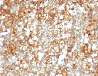 IHC: Formalin-fixed, paraffin-embedded human renal cell carcinoma stained with CD147 antibody (BSG/9