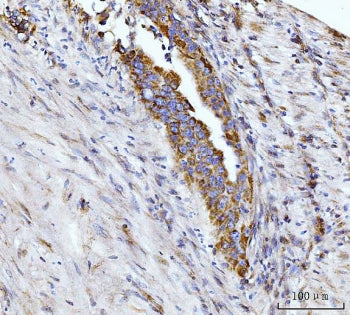 IHC staining of FFPE human appendiceal adenocarcinoma tissue with Glutaminase antibody. HIER: boil t