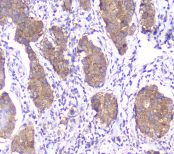 IHC testing of FFPE human breast cancer with SMN1/2 antibody. HIER: boil tissue sections in pH6, 10m
