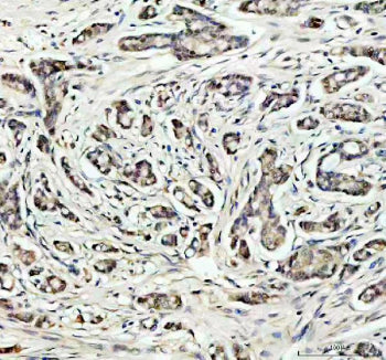 IHC staining of FFPE human breast cancer tissue with SOD1 antibody, HRP-secondary and DAB substrate.