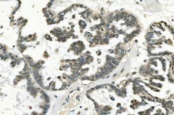IHC staining of FFPE human ovarian cancer with PHEX antibody. HIER: boil tissue sections in pH8 EDTA
