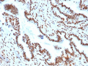 IHC testing of FFPE human endometrial carcinoma with TLE1 antibody (clone TLE1/2051). Required HIER: