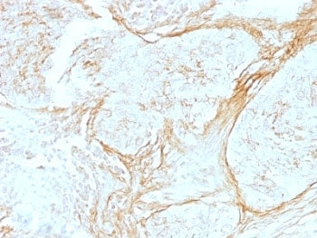 IHC: Formalin-fixed, paraffin-embedded human lung carcinoma stained with anti-Tenascin C antibody (c