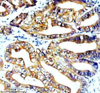 Immunohistochemical staining of STK33 using anti-STK33 antibody. STK33 was detected in a paraffin-em