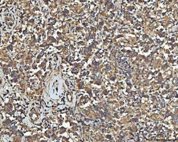 IHC staining of FFPE human testicular germ cell tumor tissue with NPEPPS antibody. HIER: boil tissue