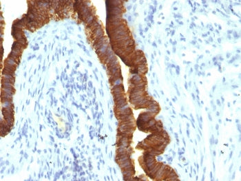 IHC testing of FFPE human ovarian carcinoma with recombinant EpCAM antibody (clone rEGP40/1110). Req