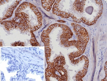 IHC staining of FFPE human prostate carcinoma tissue with EpCAM antibody (clone EGP40/8191R). Inset: