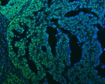 Immunofluorescent staining of FFPE human ovarian cancer tissue with SAP130 antibody (green) and DAPI